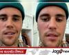 Justin Bieber is suffering from a rare disease, his face is numb!